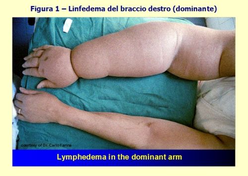 Il linfedema del braccio dominante compromette l'autonomia della donna perfino nelle più semplici attività quotidiane. Può provocare dolore e sfigura l'immagine corporea e la percezione di sé.